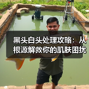 黑头白头处理攻略：从根源解救你的肌肤困扰（图2）